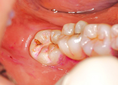 親知らずにできた虫歯。穴は小さく見えるが、虫歯が奥深くに進行している