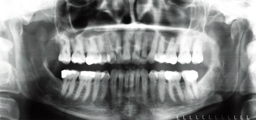 口腔内を大きく診る、パノラマレントゲン写真