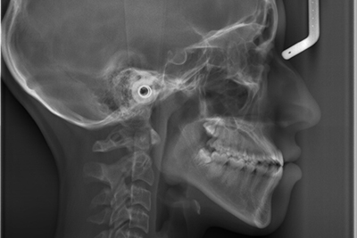 
 下顎前突のレントゲン写真