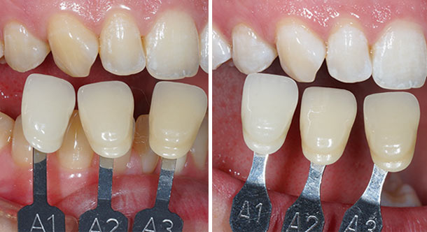 ホワイトニング（約20分の施術）の術前（写真左）・術後（写真右）